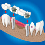 Implants dentaires