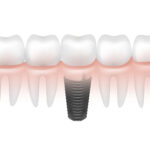 Implants dentaire