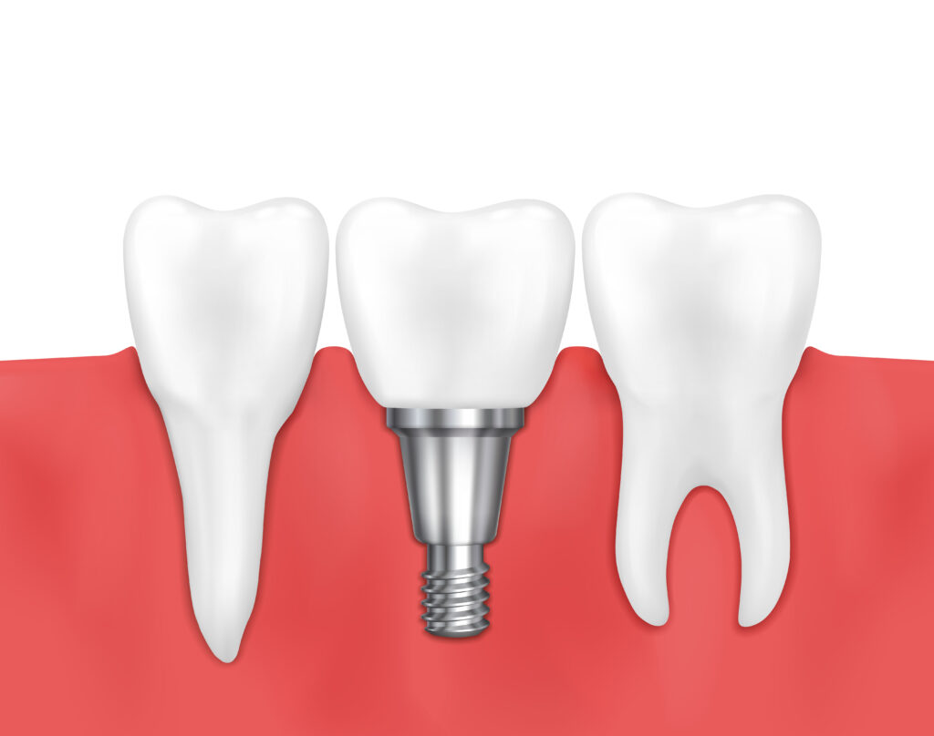remboursement implants dentaires