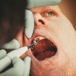 Kyste odontogène : diagnostic et prise en charge chirurgicale