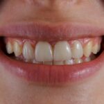 Comment corriger le jaunissement des dents après un traitement avec ondodontie avec gouttièrese via