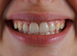 Comment corriger le jaunissement des dents après un traitement avec ondodontie avec gouttièrese via