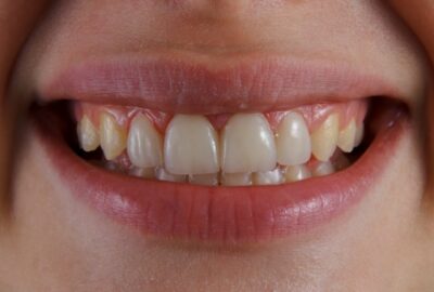 Comment corriger le jaunissement des dents après un traitement avec ondodontie avec gouttièrese via